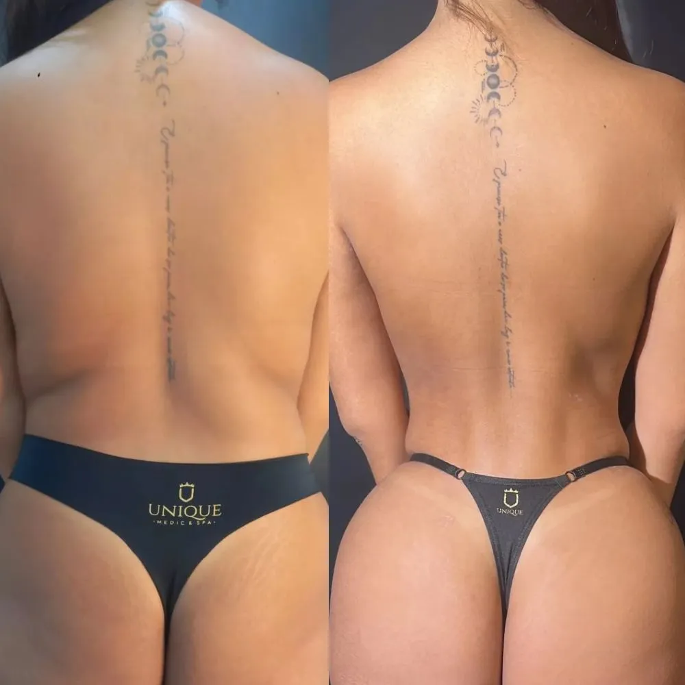 Antes e depois — resultado real